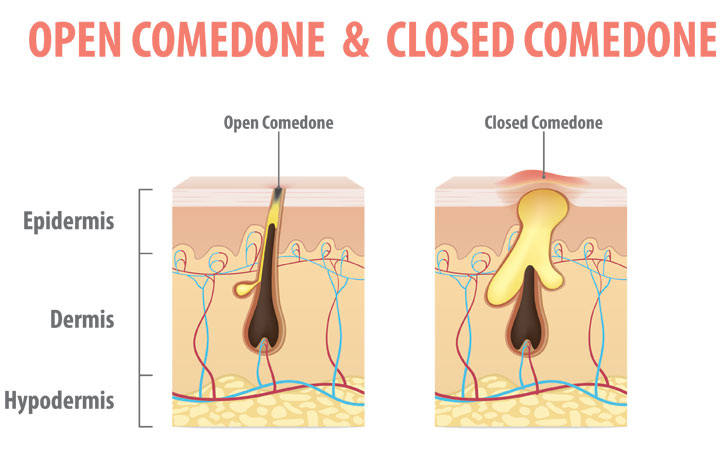 Cómo deshacerse de los comedones cerrados: causas y métodos de tratamiento eficaces
