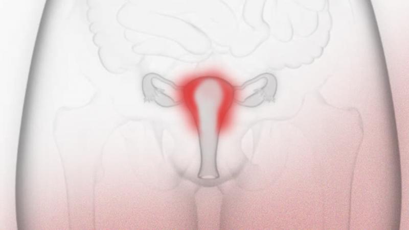 Contraindicaciones de la histeroscopia