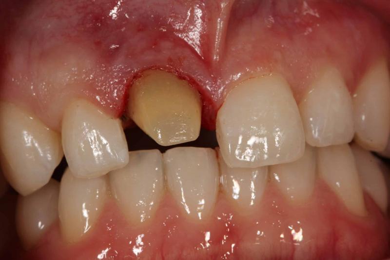 Caballo oscuro: qué hacer si un diente es más oscuro que los demás (4 formas de solucionar el problema)