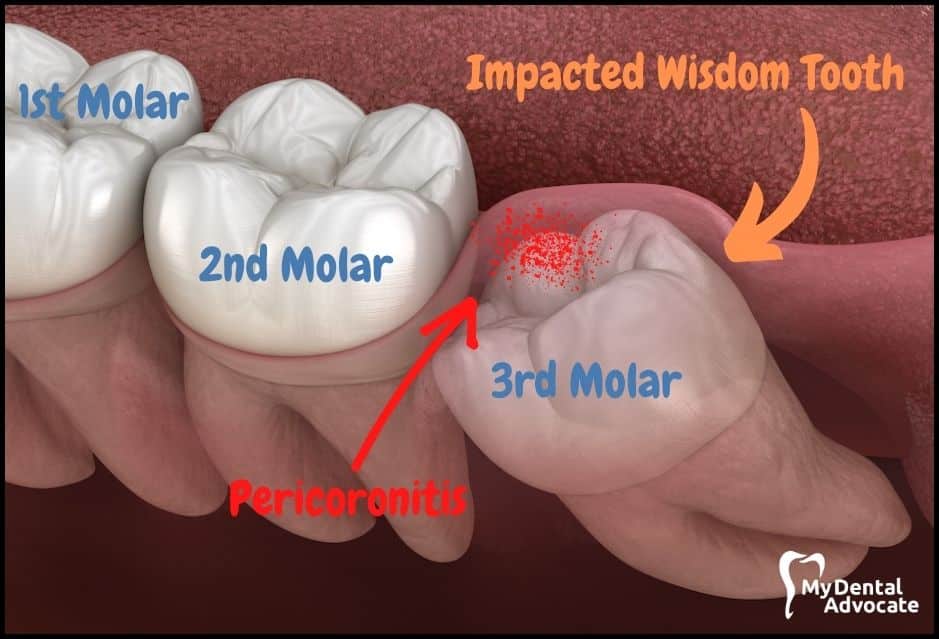 Gárgaras con decocciones