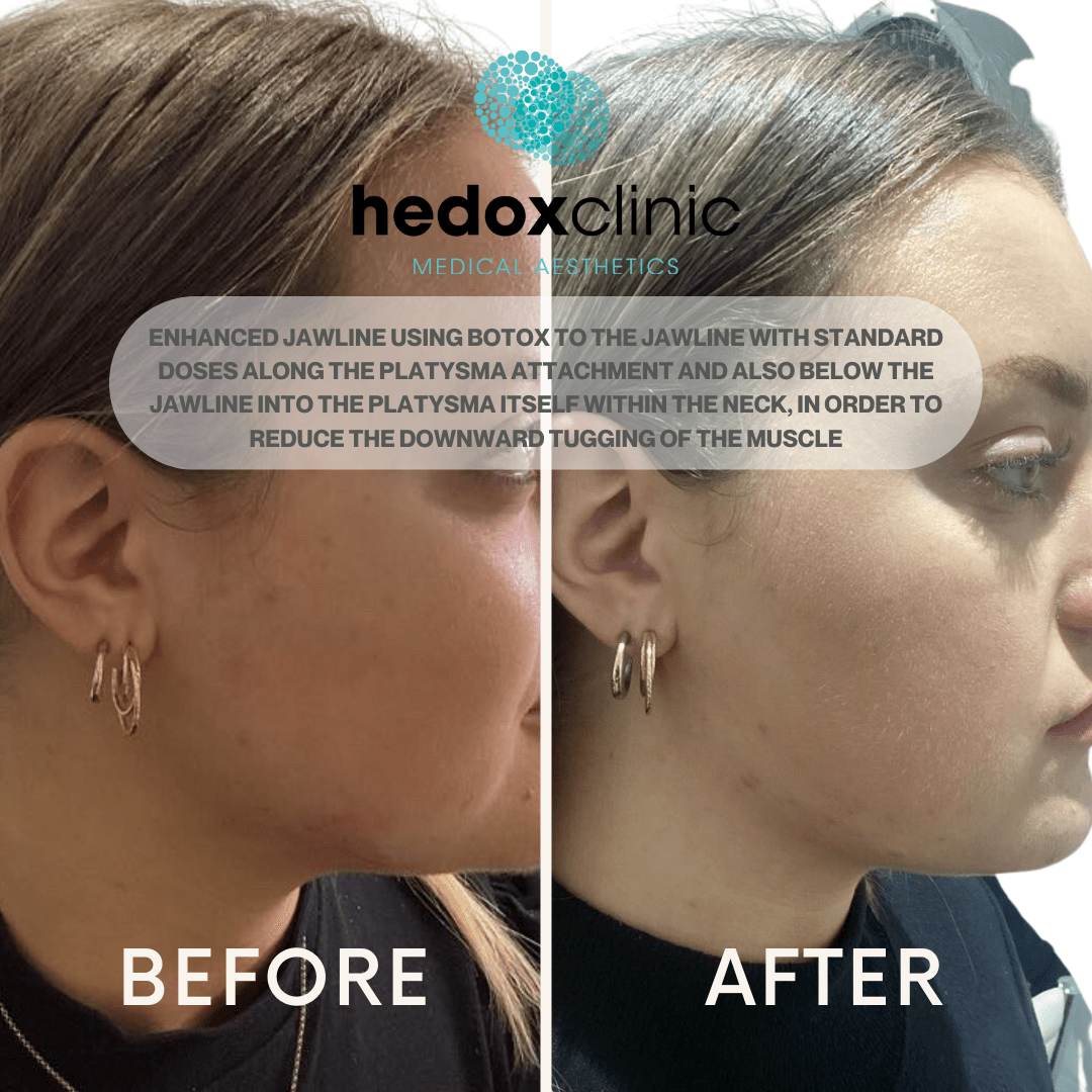 En nuestra búsqueda de la eterna juventud, buscamos constantemente formas nuevas e innovadoras de hacer retroceder el reloj y conseguir un aspecto más juvenil. Una zona que a menudo muestra signos de envejecimiento es el cuello, con piel flácida y arrugas que se hacen más prominentes con el tiempo. Pero no tema, porque un nuevo tipo de microcirugía está aquí para ayudarle: 