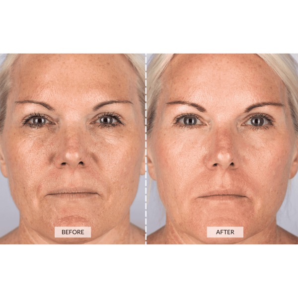 RF-lifting facial y corporal: cómo rejuvenecer sin dolor ni cirugía