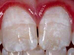 Manchas blancas en los dientes de un niño y un adulto: principales causas y métodos para eliminarlas