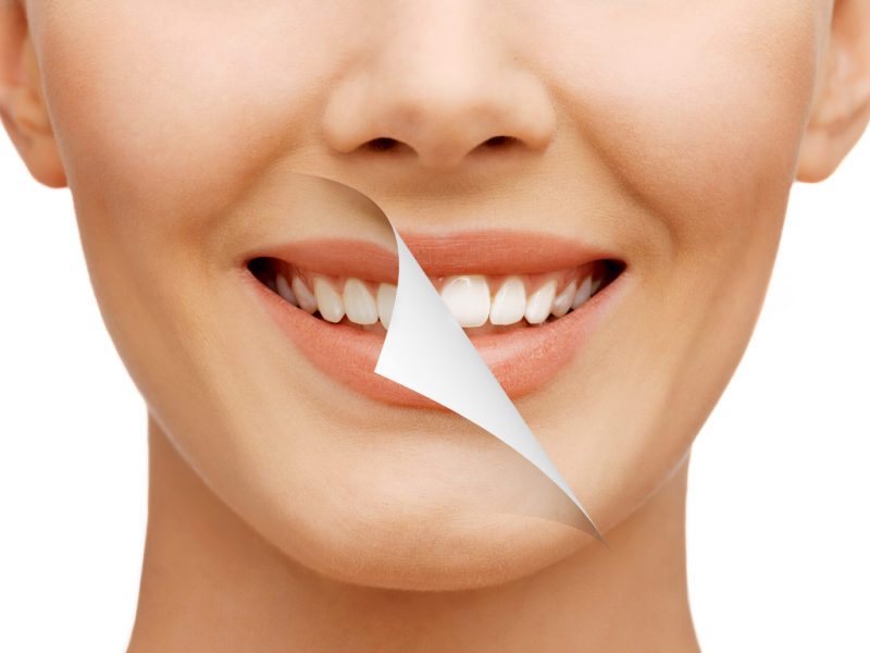 Verdades y mitos sobre el blanqueamiento dental