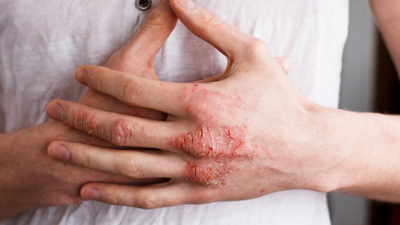 Picor en la piel: causas que quizá no sabías que tenías