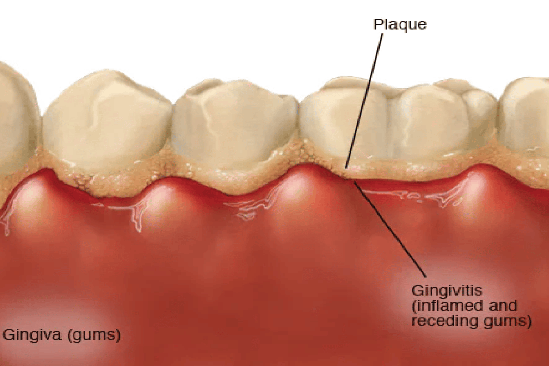 Gingivitis: qué es y cómo tratarla