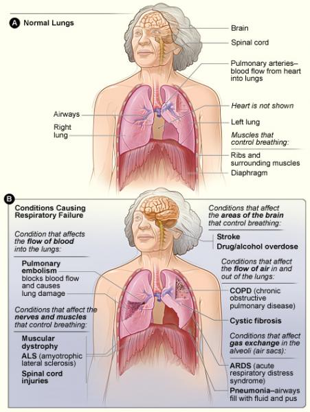 Falta de oxígeno en el cerebro: síntomas y tratamiento