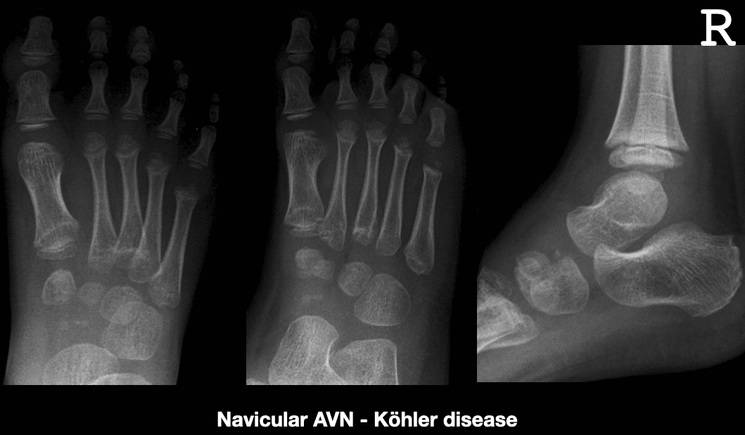 Osteocondrosis: qué es esta enfermedad y cómo tratarla adecuadamente