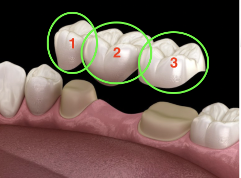 Sin espacios vacíos: 5 razones por las que debería restaurar los dientes perdidos