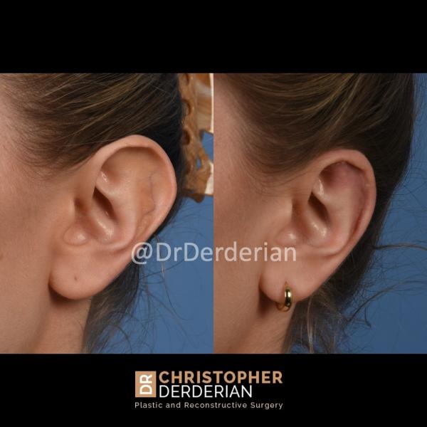 ¿Quién necesita una cirugía de orejas?