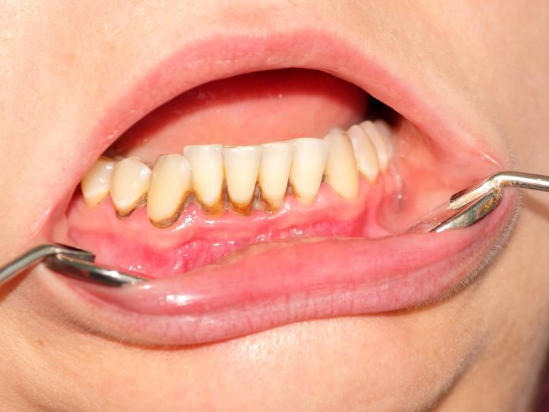 5 causas de la decoloración de los dientes