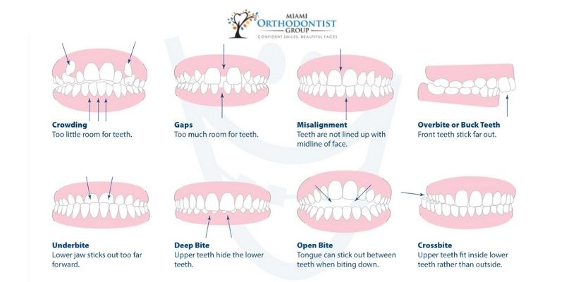 Brackets o alineadores: cómo elegir un método de corrección de la mordida