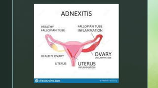 Causas de la anexitis