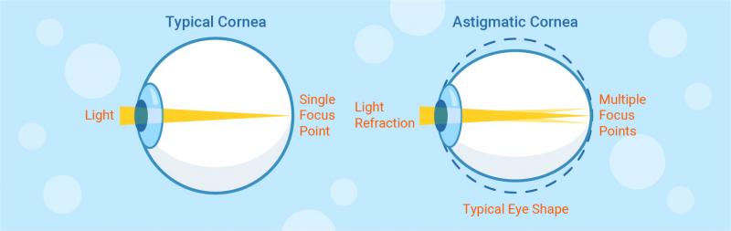 Tratamiento del astigmatismo: 3 formas principales (y cómo determinarlo usted mismo)