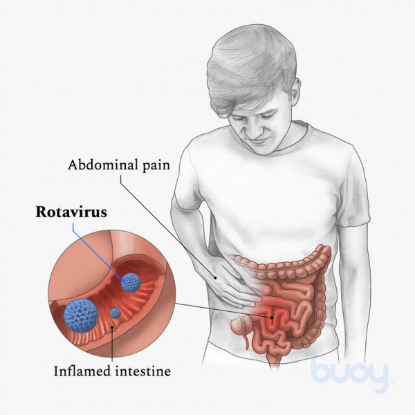 Además, la gravedad y la duración de los síntomas también pueden indicar si se trata de una intoxicación o de una infección por rotavirus. Los síntomas de intoxicación pueden ser más graves y durar menos tiempo, mientras que los de una infección por rotavirus pueden ser menos graves pero persistir durante varios días.