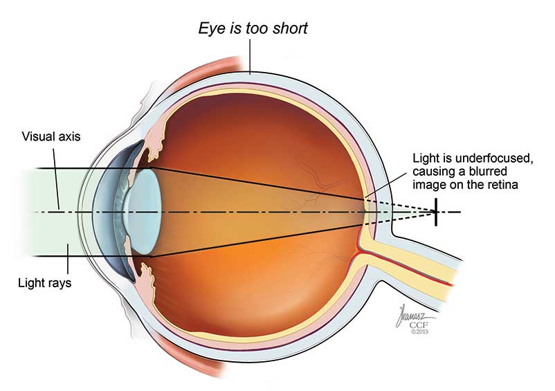 Causas inesperadas de problemas de visión (y relación de la miopía con los pies planos)