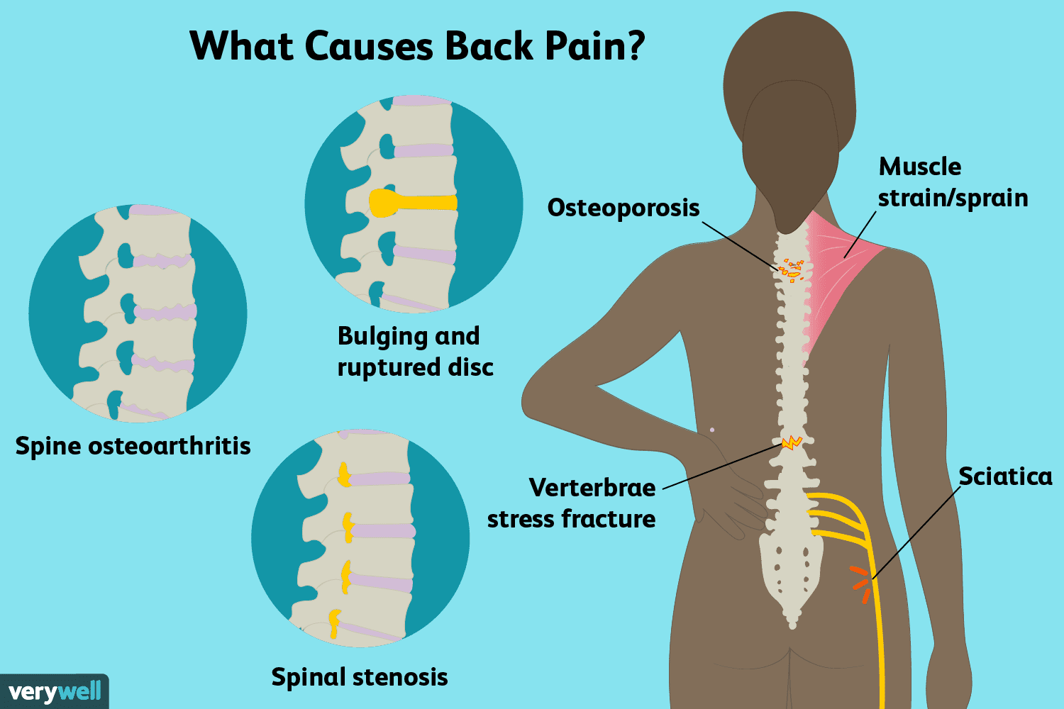 Lumbalgia: causas