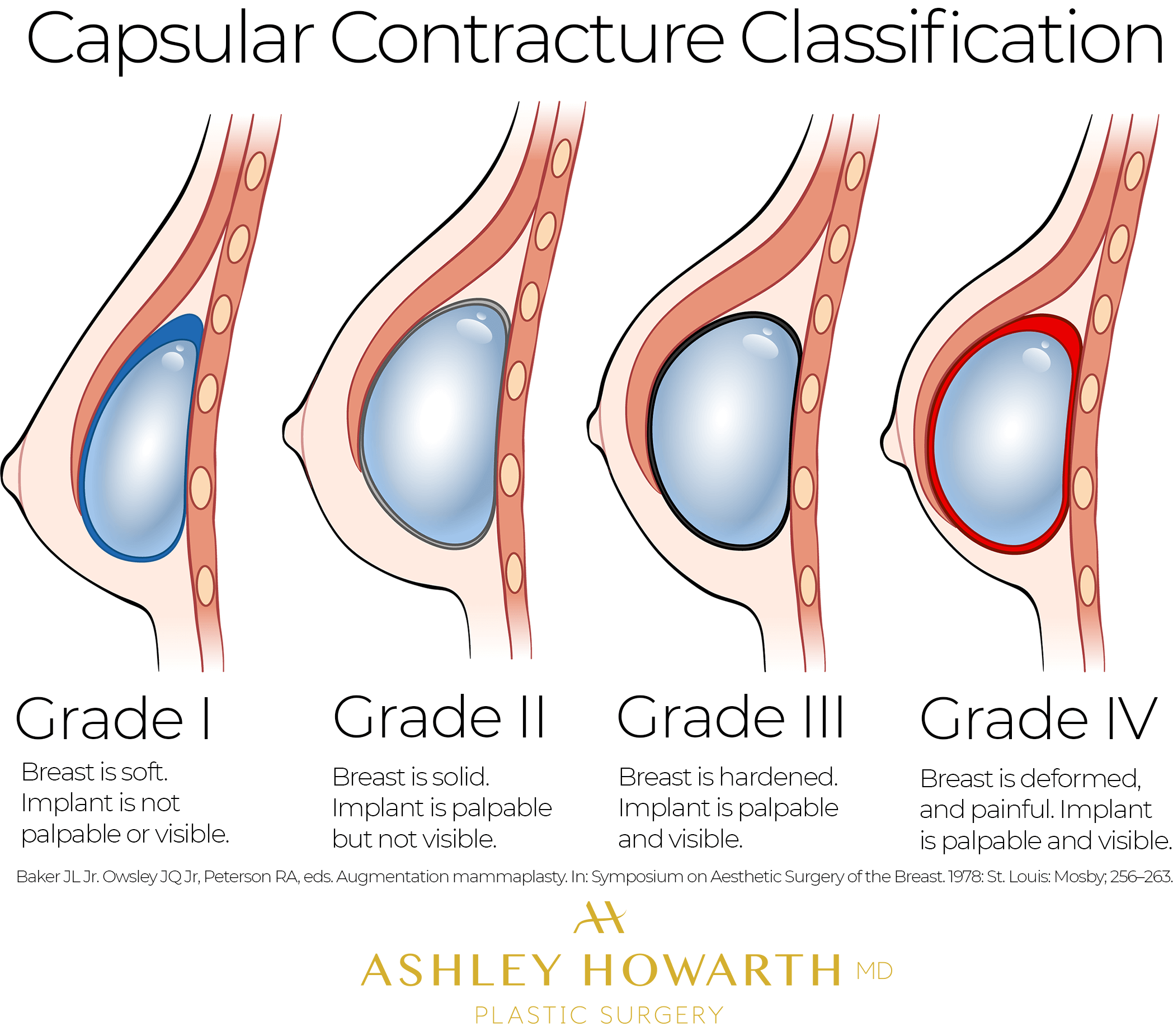 Más sobre implantes