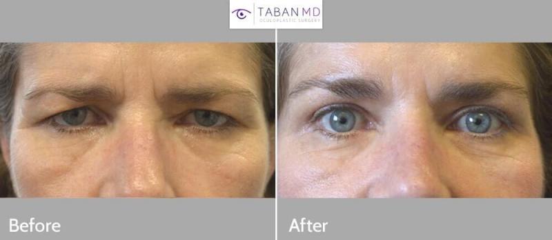 Lifting frontal y de cejas endoscópico: cómo rejuvenecer años en una sola intervención