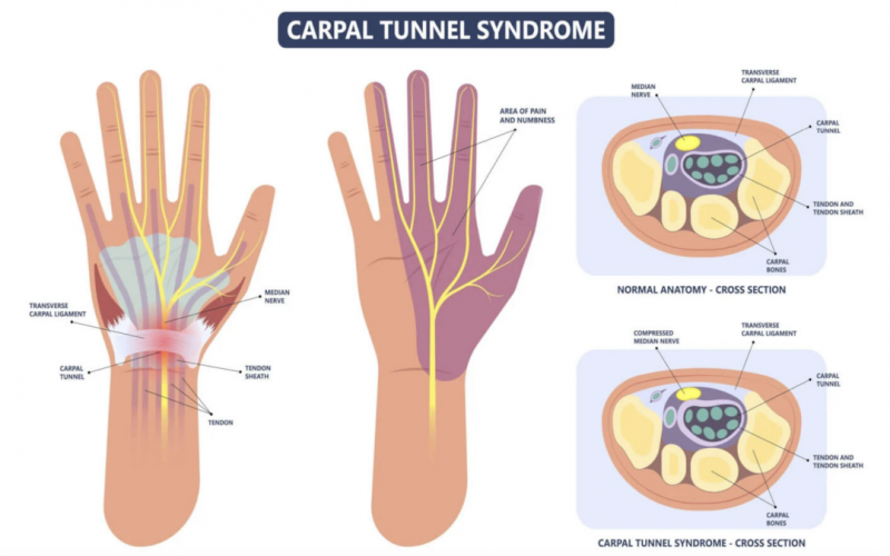 Qué es el síndrome del túnel carpiano y cómo se trata