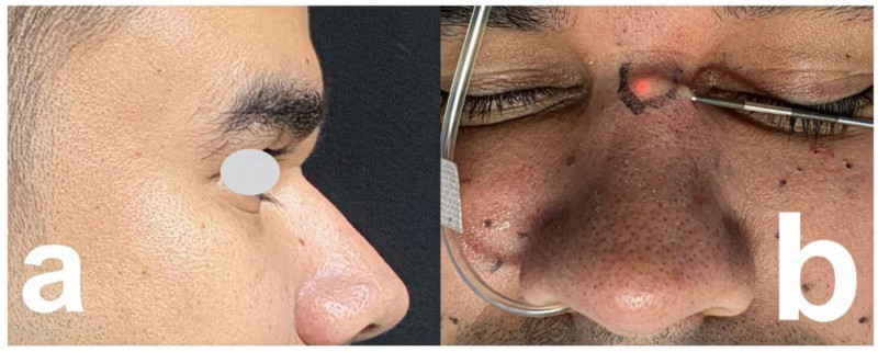 Enciclopedia de la Belleza. Rellenos: qué es - dice cosmetóloga