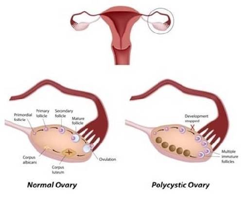 Síndrome de ovario poliquístico: por qué se produce y cómo curarlo rápidamente