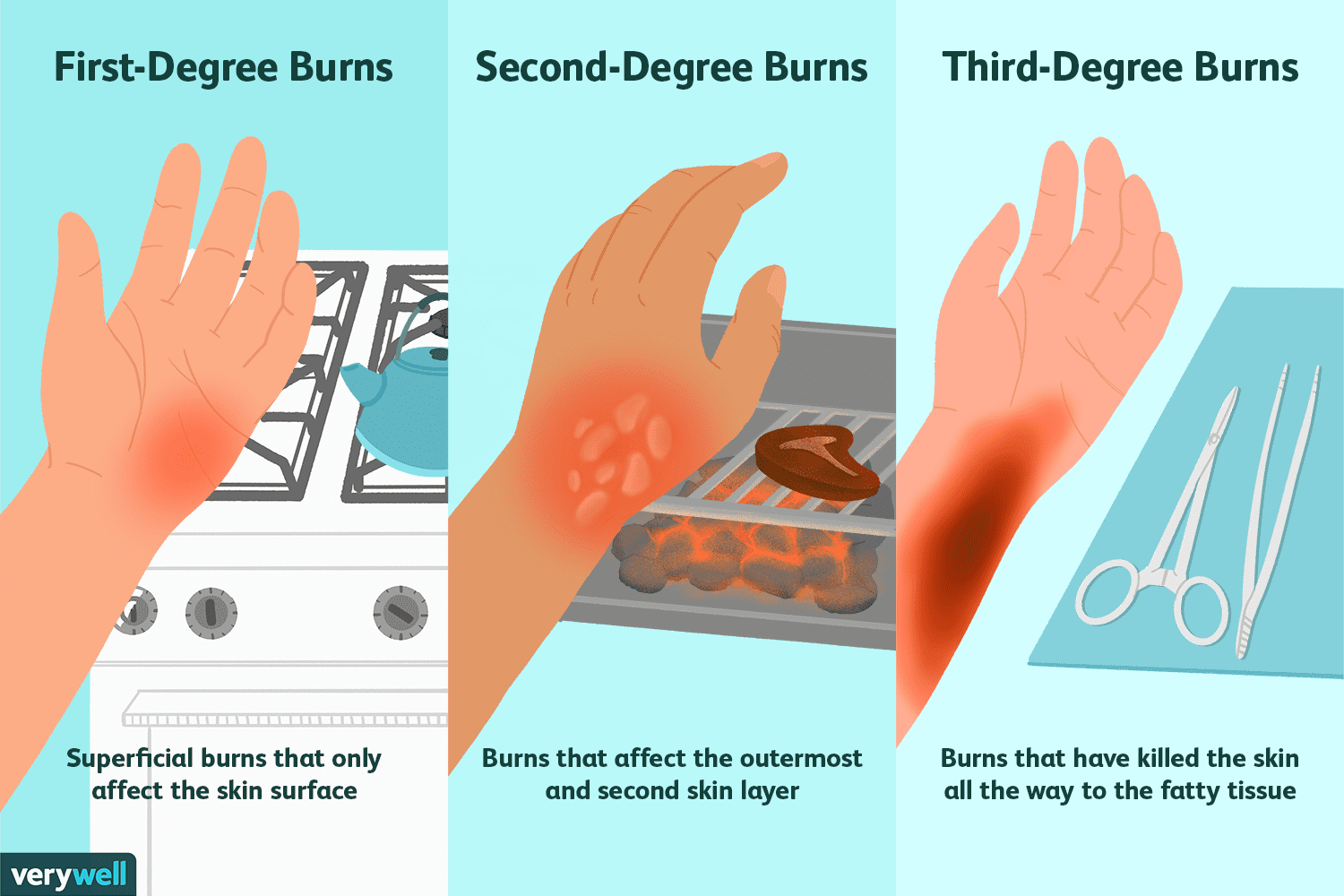 Cómo determinar la gravedad de las quemaduras