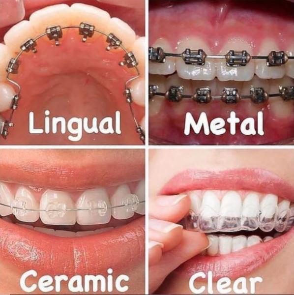 Tipos de ortodoncia: coste y diferencias