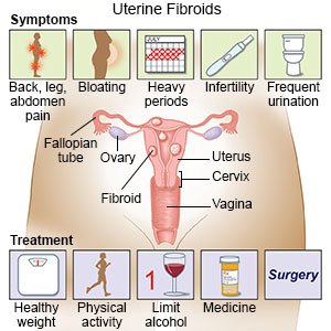 3. ¿Cómo funciona la embolización de la arteria uterina?