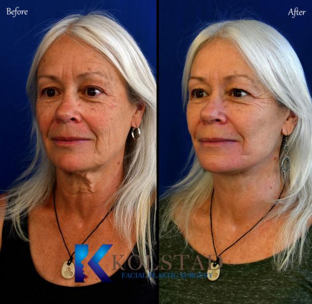 2 procedimientos de rejuvenecimiento en lugar de un lifting facial para no parecer un globo inflado