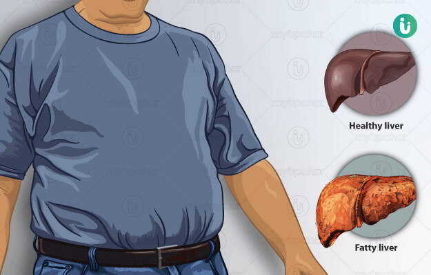 Hígado graso: qué es peligroso y cómo evitarlo