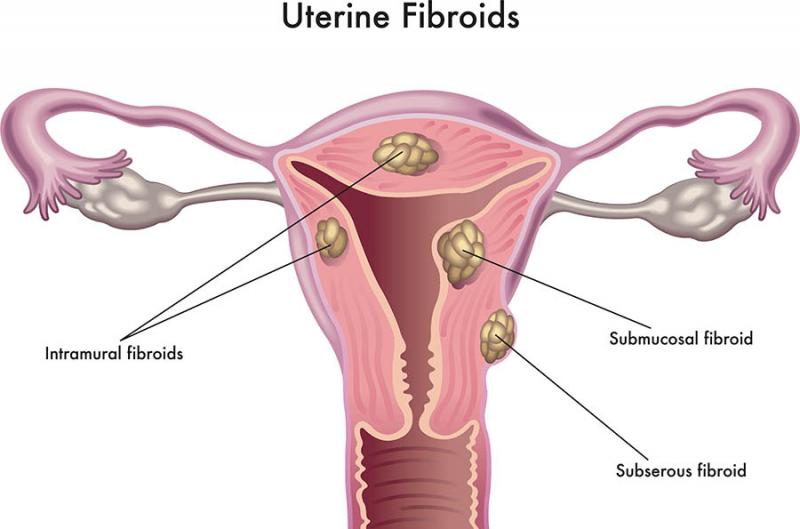 Mioma uterino: una forma moderna de curarlo con seguridad