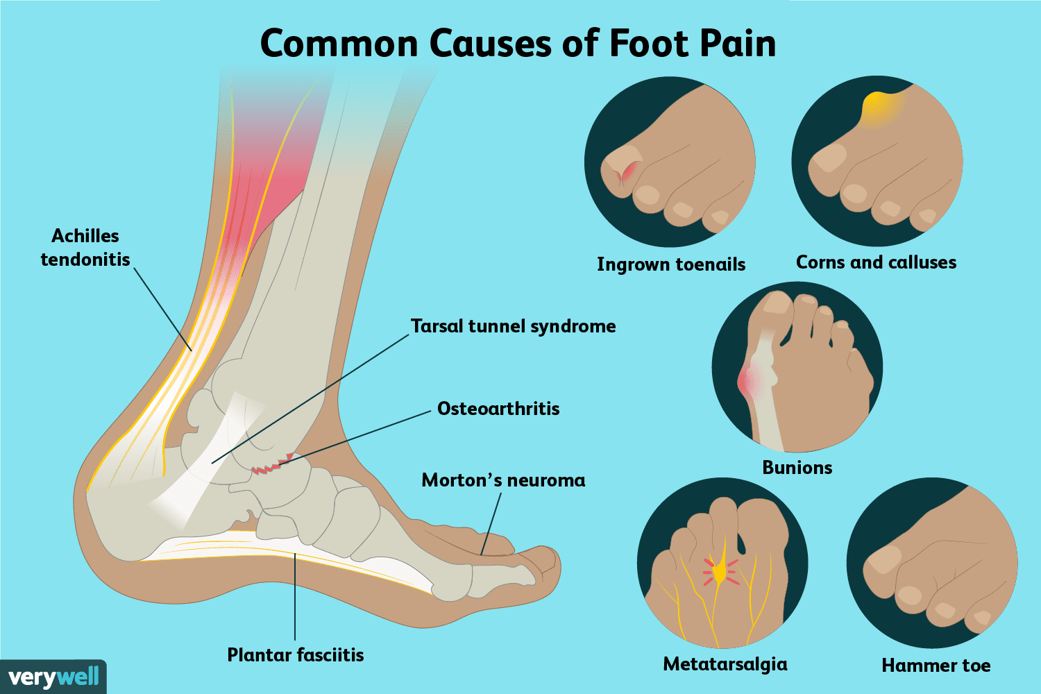 1. Osteoartritis