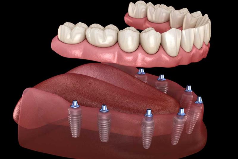 5 Mito: No tiene sentido pagar de más por una marca de implantes.