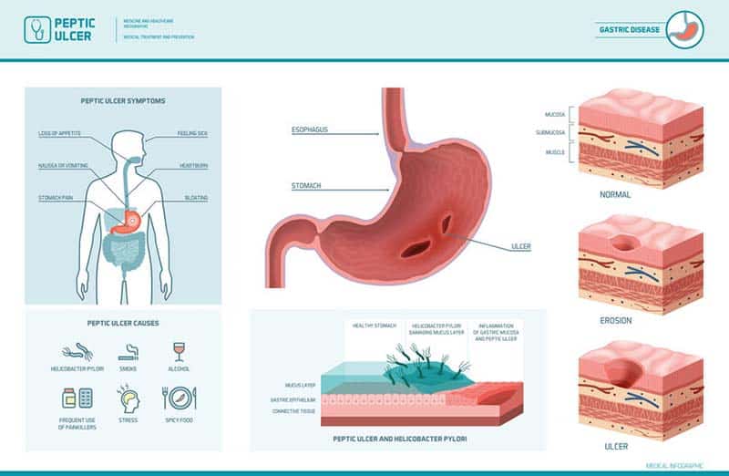 Tratamiento de la gastritis superficial