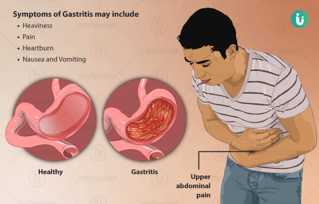 Gastritis superficial: síntomas y tratamiento en adultos