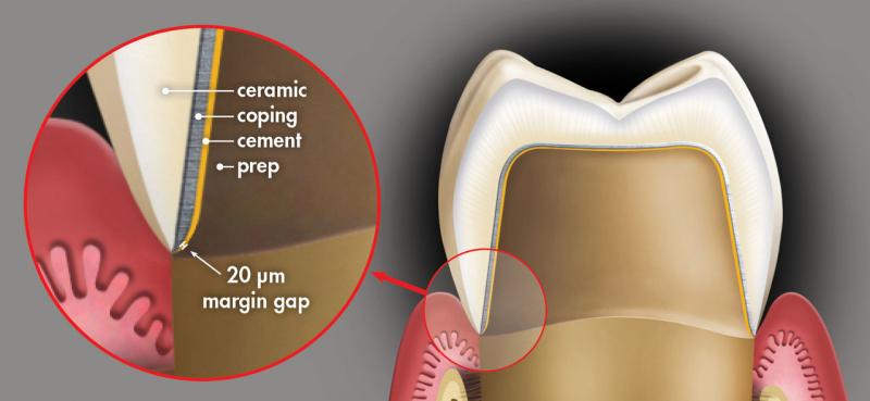 Qué corona dental elegir: zirconia frente a metal-cerámica