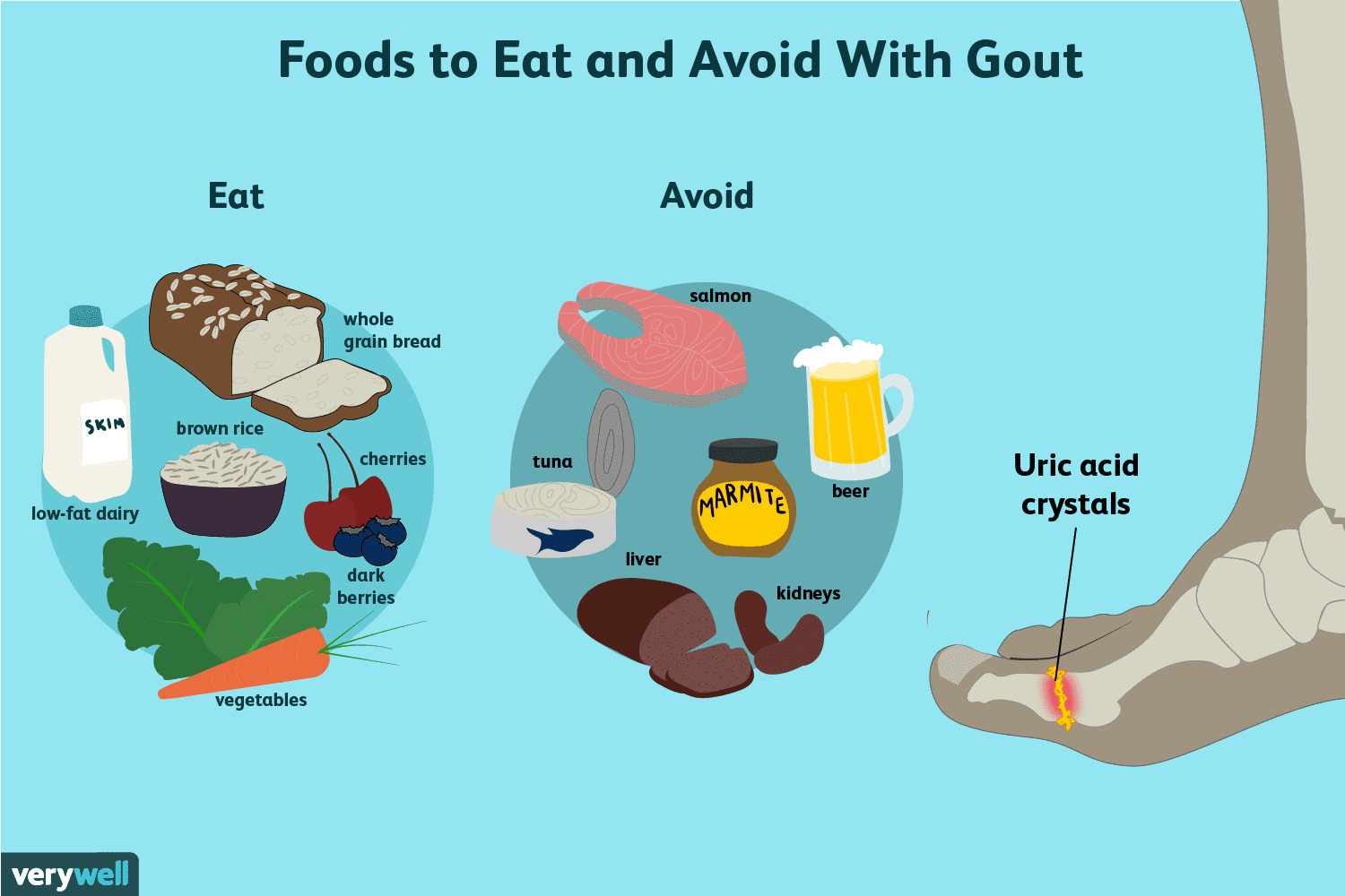 Dieta en la gota: qué es útil y qué no pueden comer los pacientes