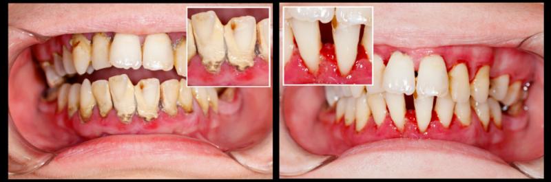 Cómo afecta la diabetes a las encías y los dientes