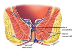 ¿Cómo prevenir las hemorroides?