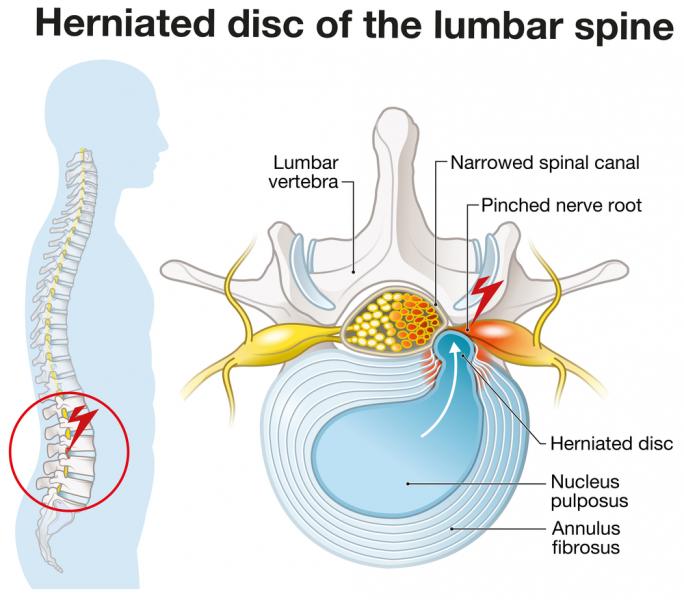 Protrusión discal espinal: ¿cuál es el peligro de esta afección?