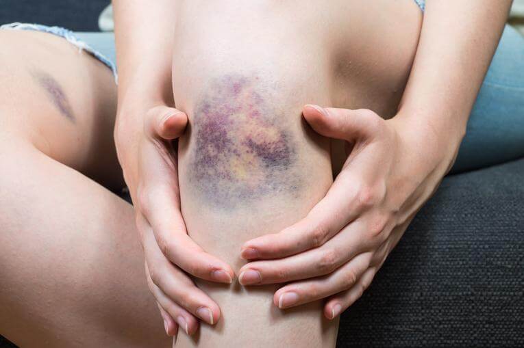 Cómo eliminar un hematoma rápidamente: 21 formas obvias (y no tan obvias) que funcionan