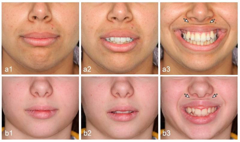 Cuáles son las causas del crecimiento del vello en los labios en las mujeres