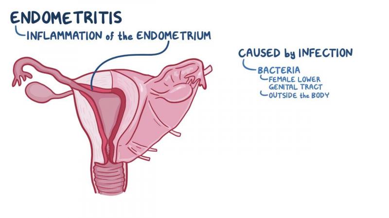 Pregunta íntima: qué es la endometritis crónica (y tratamiento adecuado de la enfermedad)