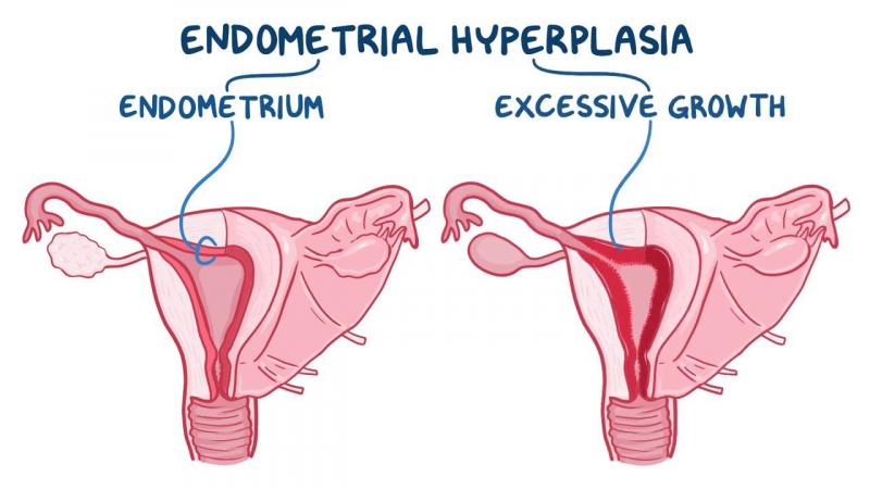 1. Hemorragia uterina anormal