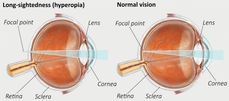 Cómo recuperar la vista: causas del deterioro y opciones de tratamiento