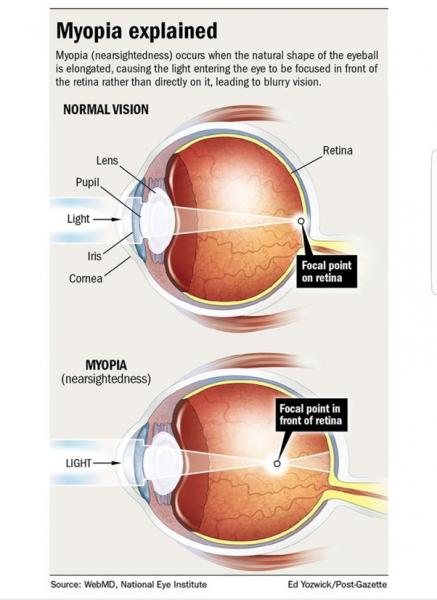Síndrome del ojo en caja