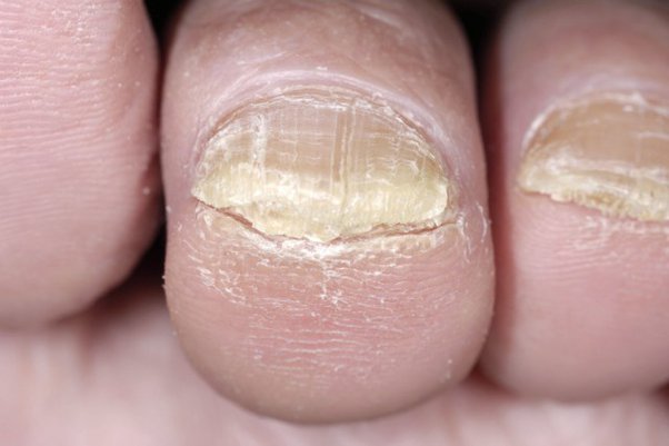 Tipos de hongos en las uñas de los pies
