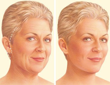 ¿Con qué puede y debe sustituir hoy un lifting facial circunferencial?