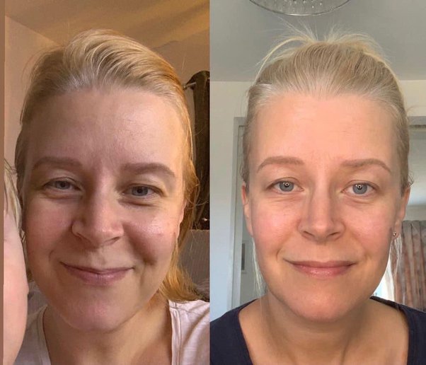Cómo eliminar las arrugas de la frente sin bótox: todos los secretos del fitness facial